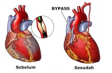 Operasi bypass jantung koroner 