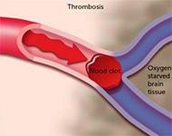 penyakit thrombosis sangat berbahaya