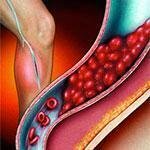 deep vein thrombus terjadi pada pembuluh darah vena