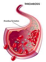 thrombosis terjadi akibat pembekuan darah