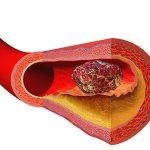 trombosis pada arteri pembuluh darah