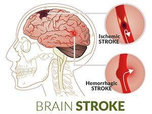 stroke iskemik atau stroke penyumbatan pembuluh darah