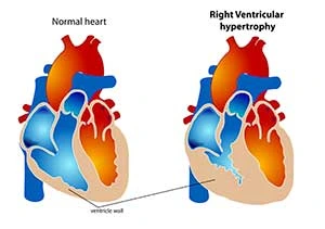 penebalan otot jantung, penyebab jantung bengkak akibat hipertensi