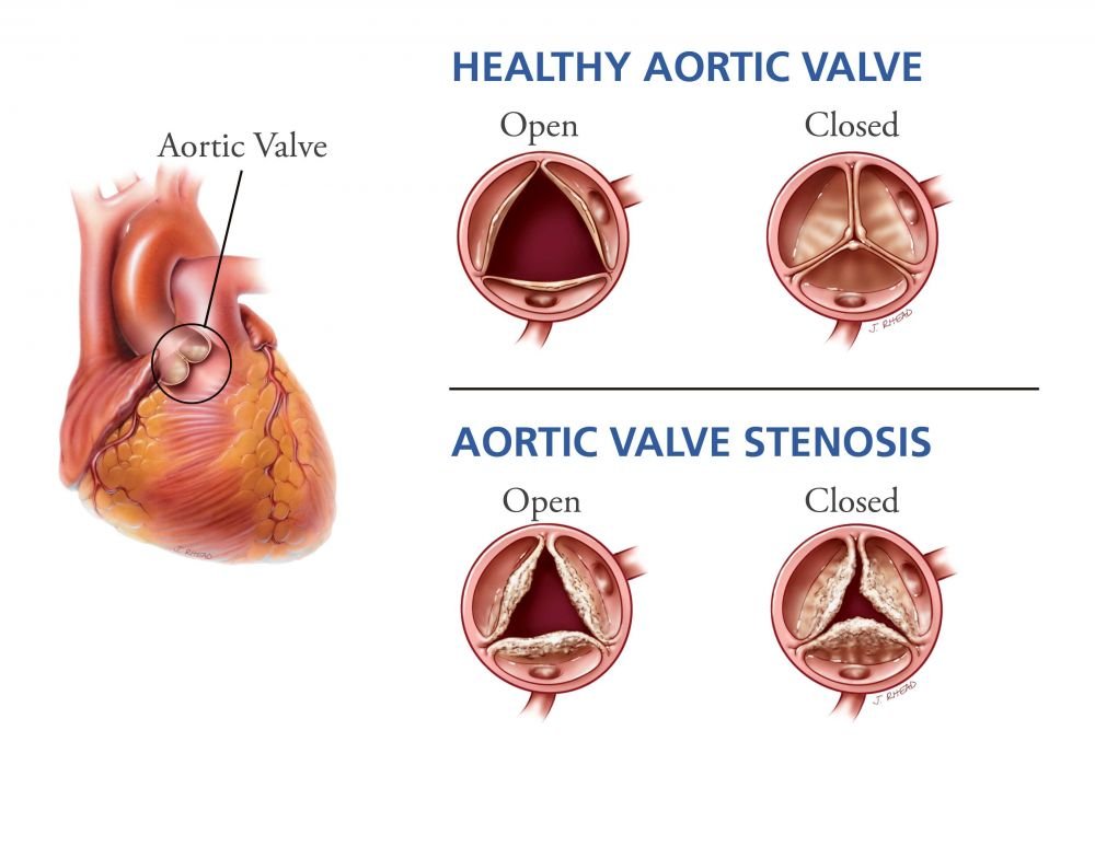 Penyakit Jantung Aorta