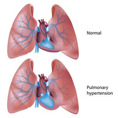 Penyakit Jantung Pulmonal