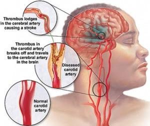 penyebab stroke adalah thrombosis