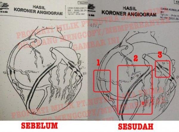 obat jantung dan obat stroke gravistro