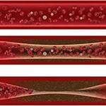 arteriosklerosis penyebab kardiovaskular