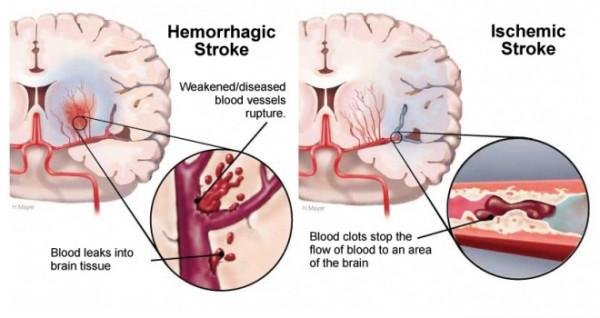 perbedaan stroke iskemik dan stroke hemoragik