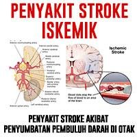 Contoh Askep Stroke Infark - Simak Gambar Berikut