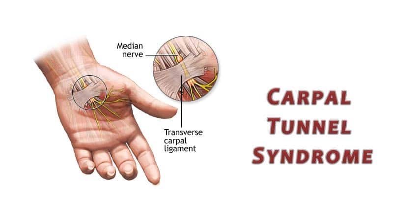Carpal Tunnel Syndrome